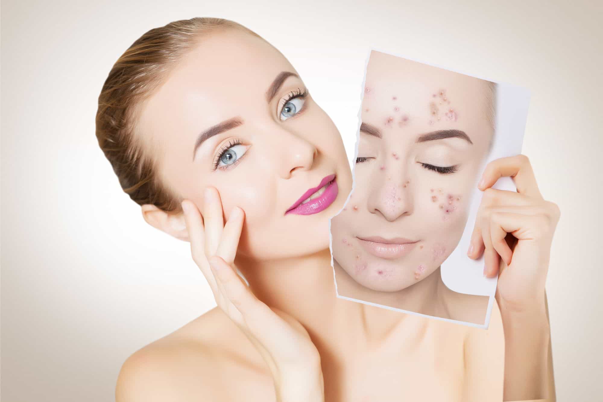 Acne Treatment Service for Lasting Results in Subang Jaya