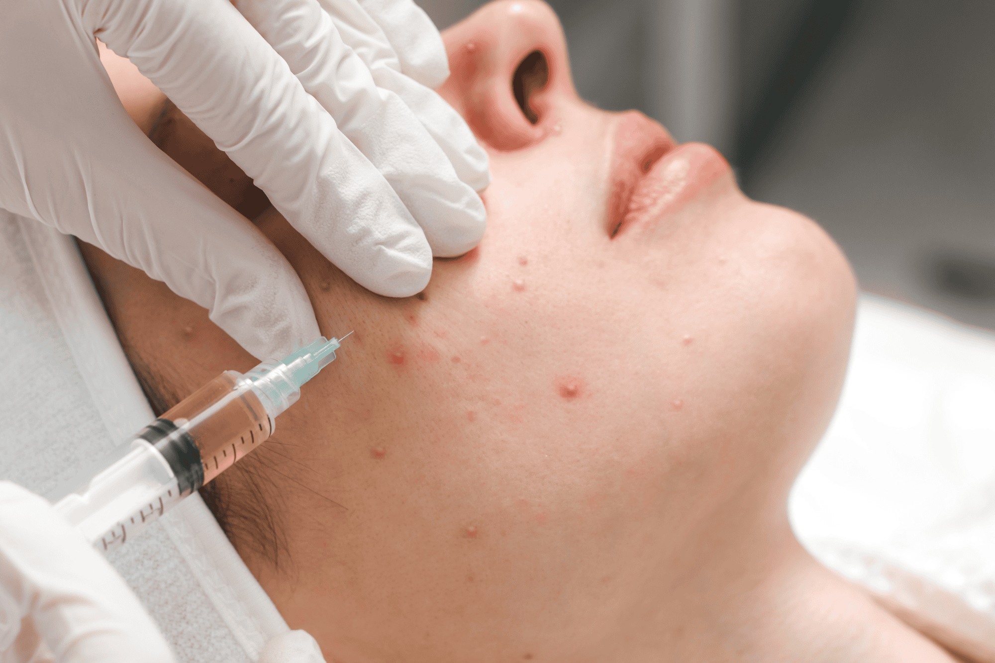 High-frequency Acne Treatment - Versatile Skincare Solution